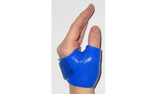 Sprained Thumb? It Could Be Skier's Thumb.
